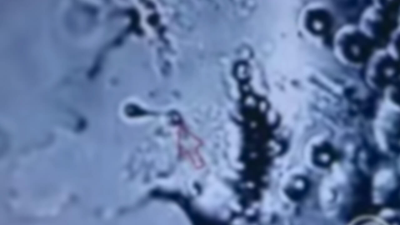 video-microscopictesticularspermextractiontese